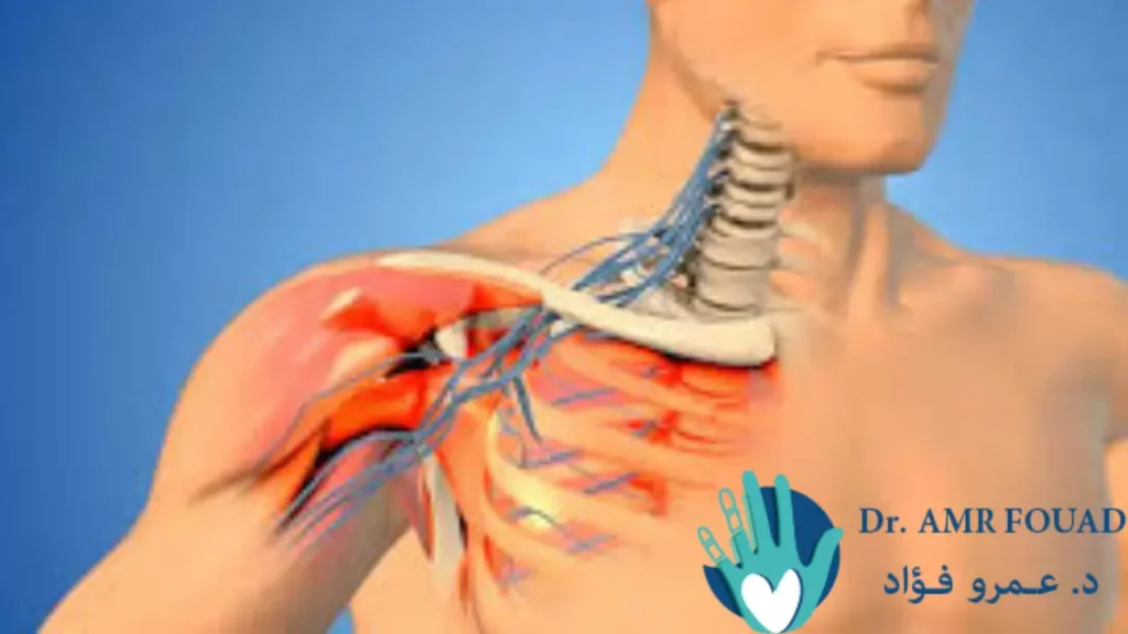 إصابة الضفيرة العضدية: الأسباب والعلاج ونسبة نجاح عملية الضفيرة العضدية