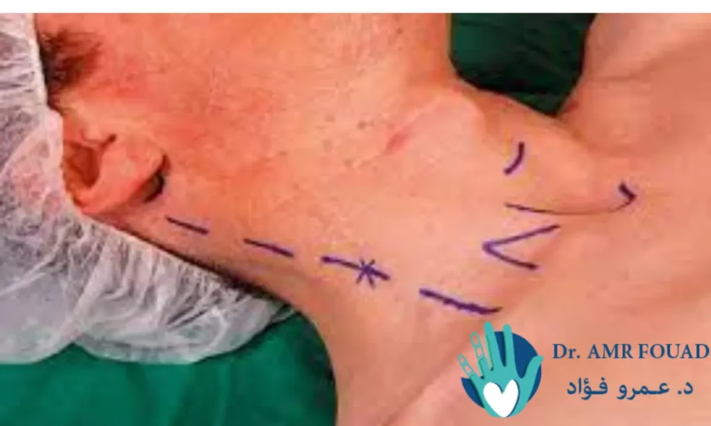 الضفيرة العصبية الرقبية 1 الضفيرة الرقبية 1