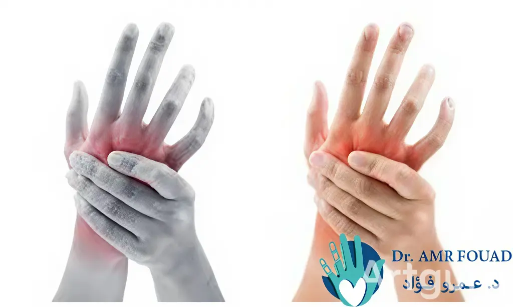 هل تنميل اليدين خطير؟ 2 هل تنميل اليدين خطير